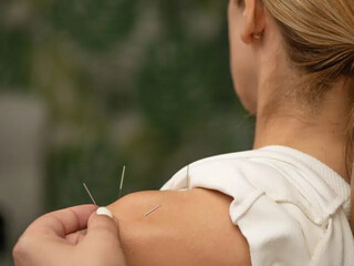 Acupuncture